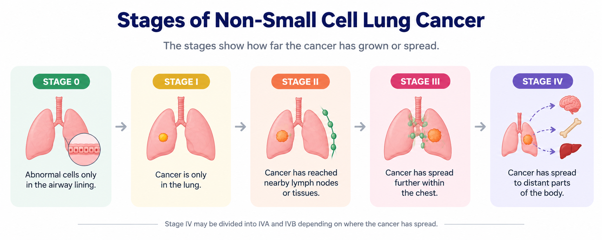 Stages of lung cancer